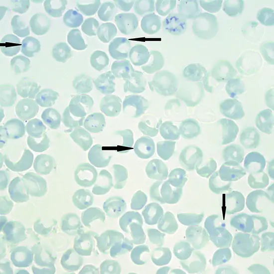 heinz bodies peripheral, blood